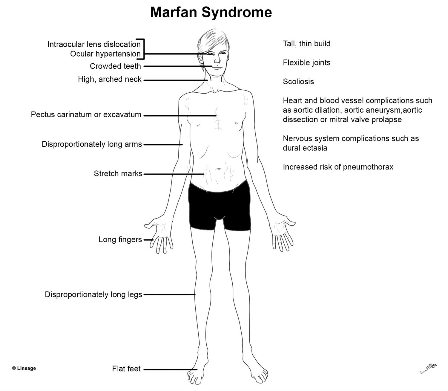 Marfan Syndrome Genetics Symptoms Diagnosis And Treatment Online