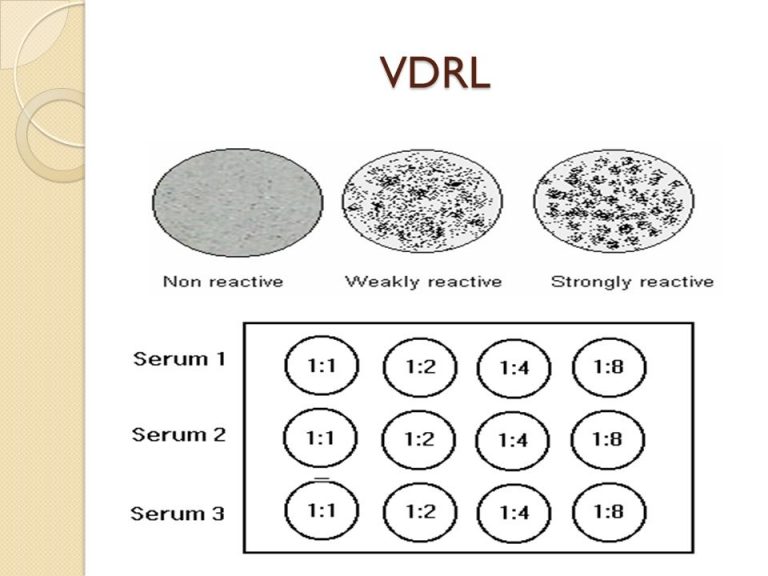 VDRL Test Principle Procedure Result Interpretation And Application Online Biology Notes