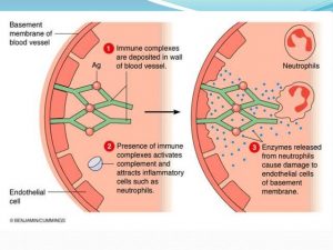 Type III hypersensitivity reaction: factors causing immune complex ...