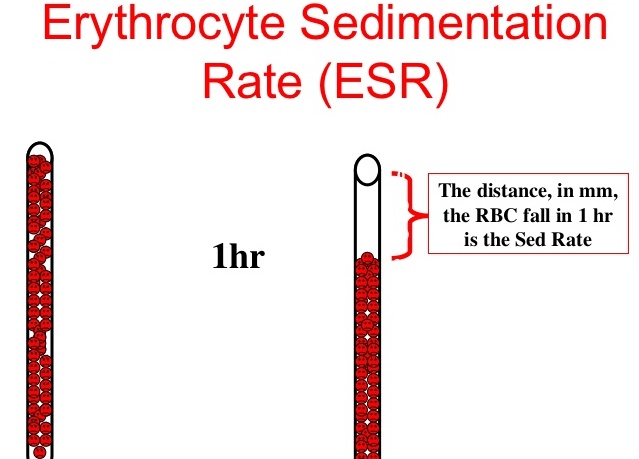 Erythrocyte Sedimentation Rate (ESR) : Significance, Mechanism, Influencing  factors, Procedure - MedicoInfo