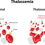 Талассемия что это. Талассемия.