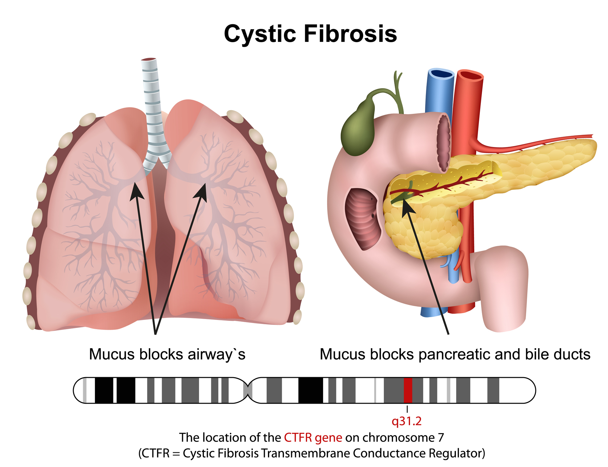 cystic fibrosis chromosome 7