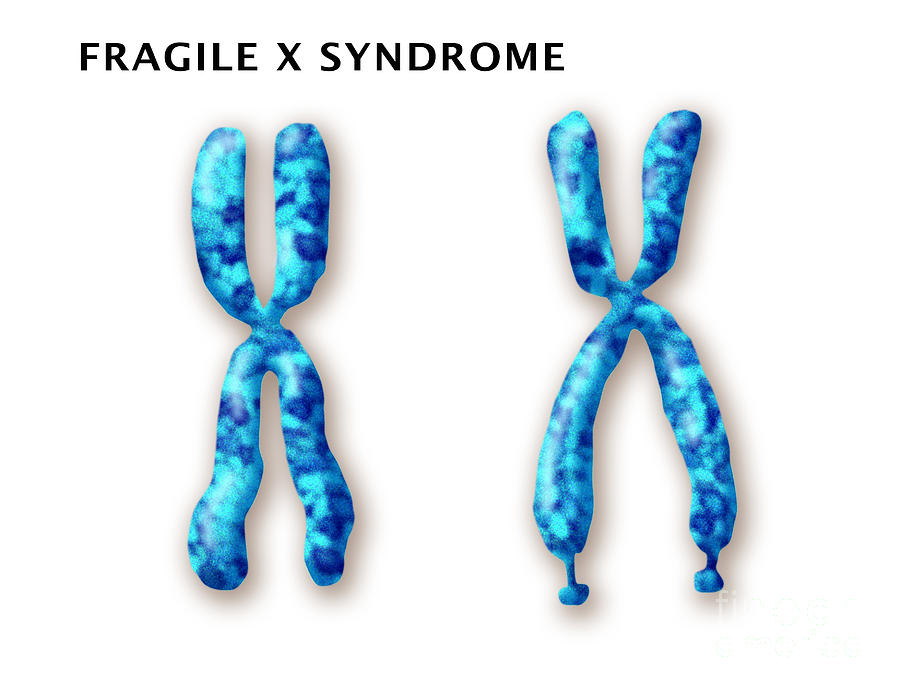 fragile x syndrome chromosome